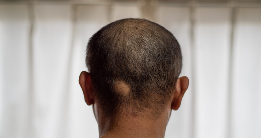 bald-spot-on-back-of-head-AdobeStock_344824988-1024x542